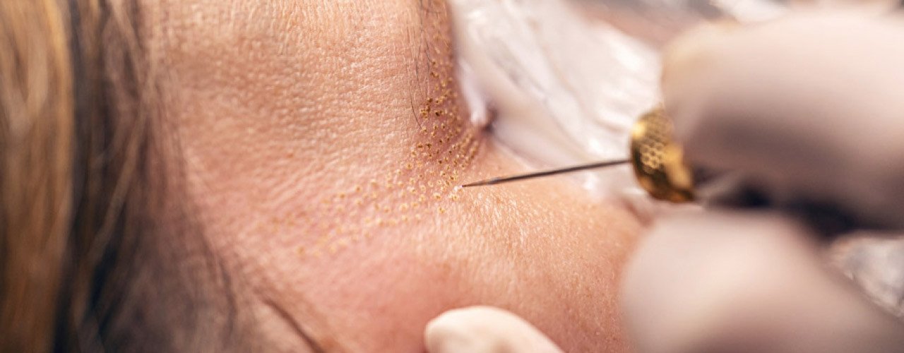 Visage Plasma Skin: Anwendung und Erwartung